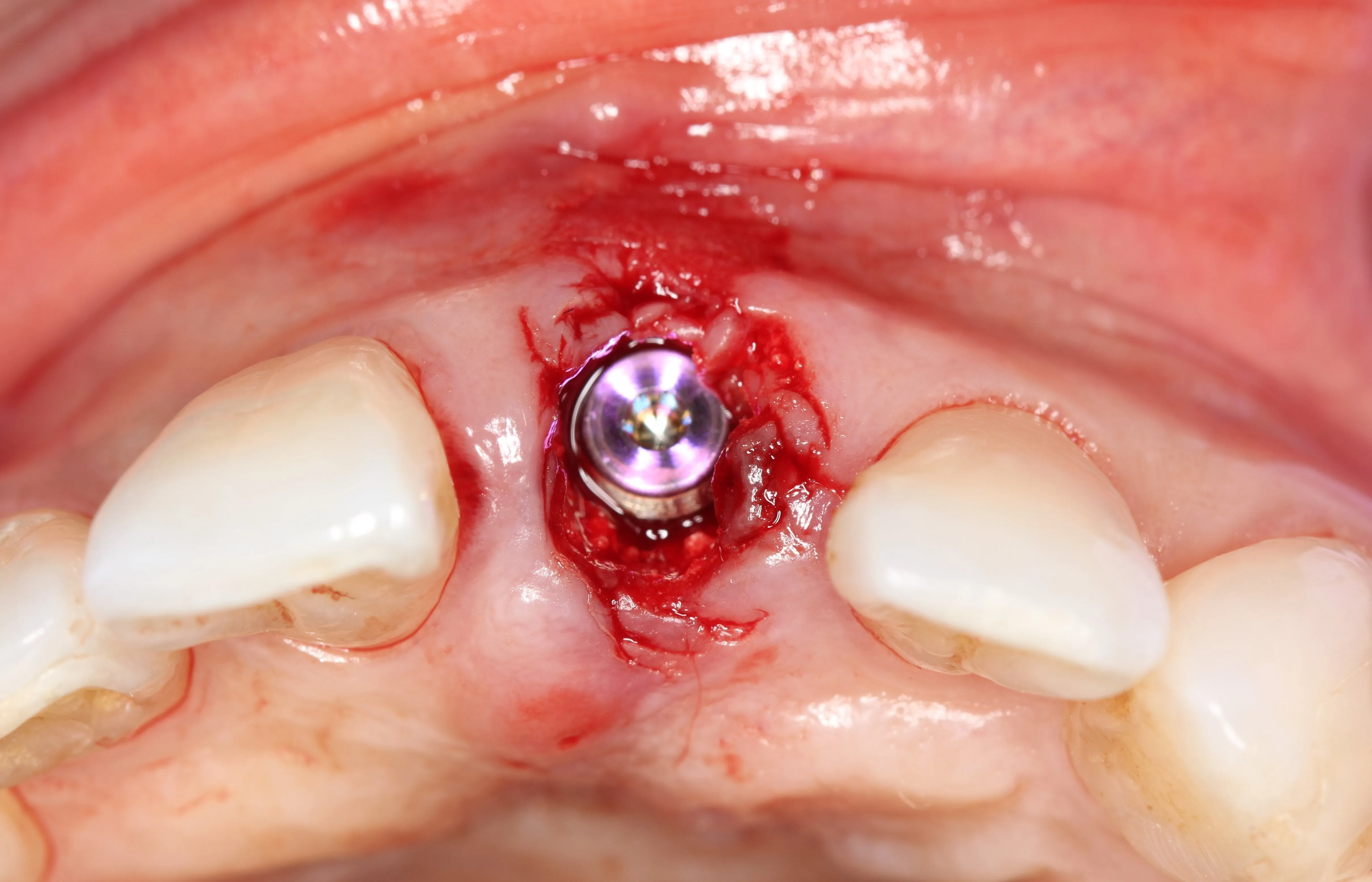 Surgical Placement of Dental Implants: A Restorative-Driven Approach