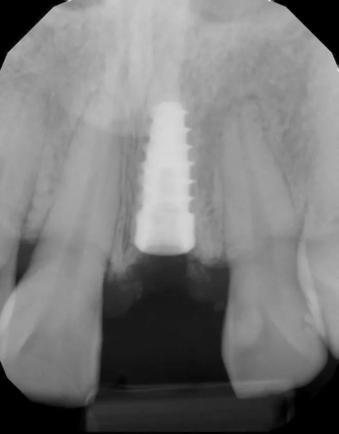 Surgical Placement of Dental Implants: A Restorative-Driven Approach